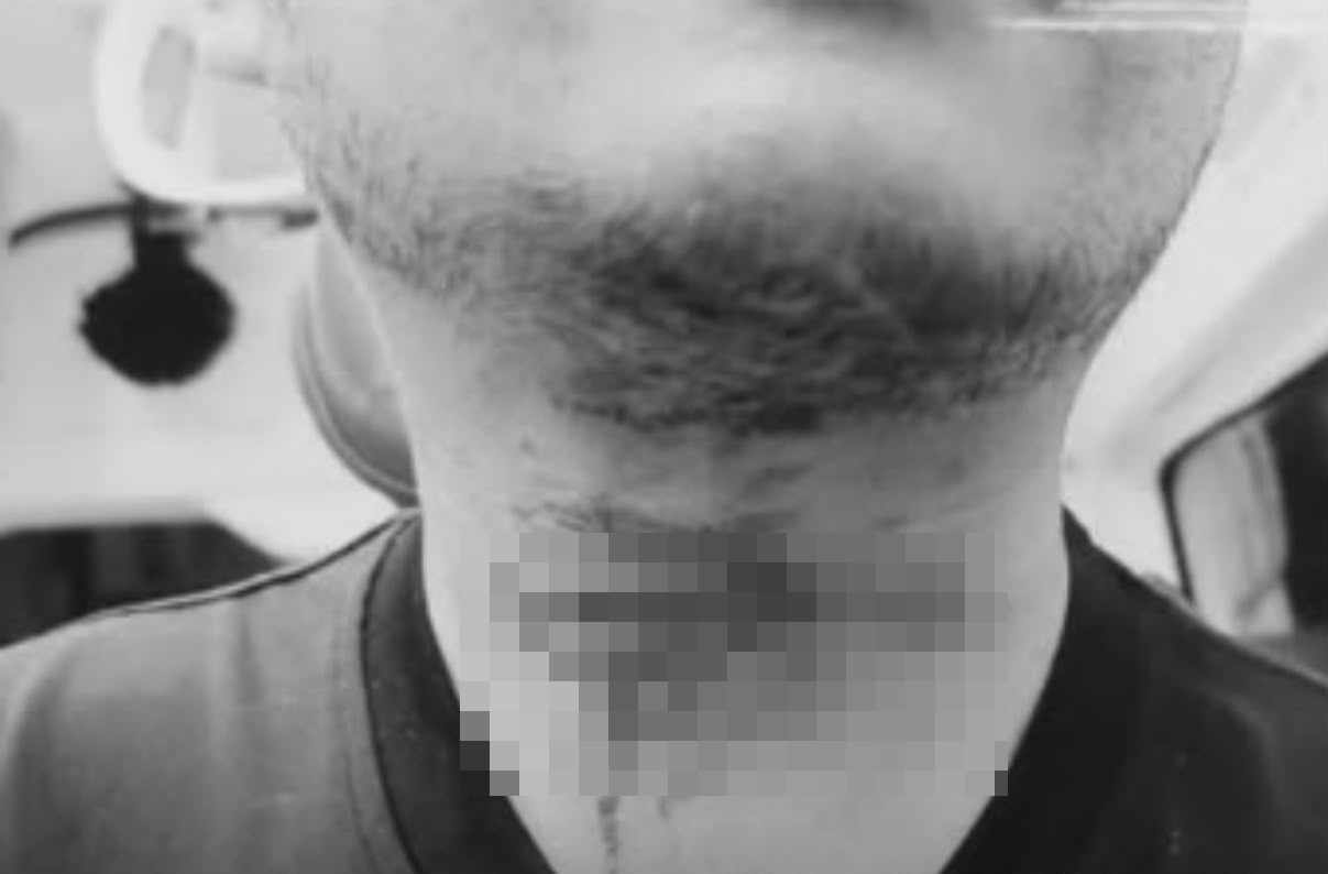 男子上传其颈部受伤的照片。 男子上传其颈部受伤的照片。